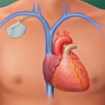 Pacemaker-&-Defibrillator-Monitoring in Long Island