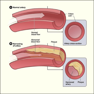 Angina Treatment Long Island Heart Health Medical Pllc