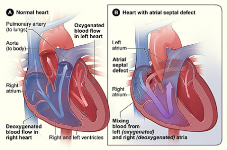 os asd full form in cardiology