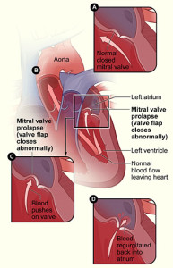 mitral-valve-prolapse