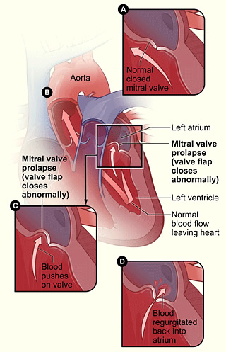 pic-mitral-valve-prolapse | Heart and Health Medical