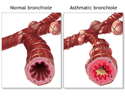 Normal and Asthmatic Bronchiole