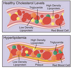 hyperlipidemia