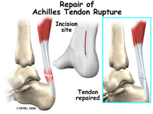 Achilles Tendon Repair Treatment