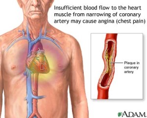 angina pic
