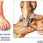 Ankle Sprain Type 1