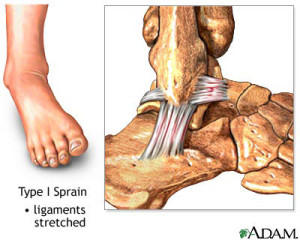 ankle-sprain-type-1-300x240 Podiatrist