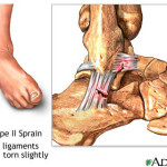 Ankle Sprain Type 2