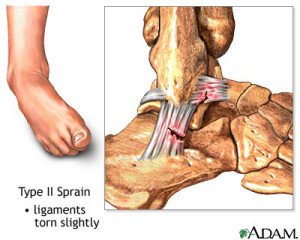 ankle-sprain-type-2-300x240 Podiatrist