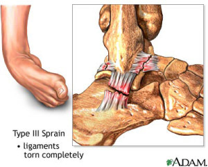 ankle-sprain-type-3-300x240 Podiatrist