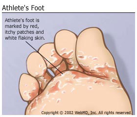 Athlete's Foot treatment by podiatrist