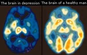 Brain Scan of Depression