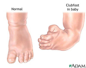 Clubfoot can be treated by podiatrists at heart and health