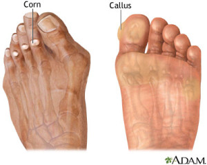 Podiatry Department Treats Corns and Callus