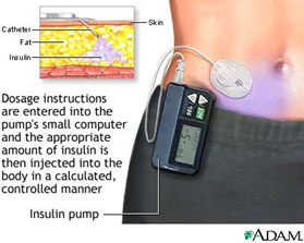 Insulin Pump