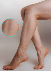 Treated Varicose Veins