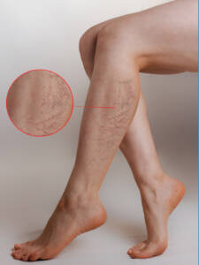 Untreated Varicose Veins