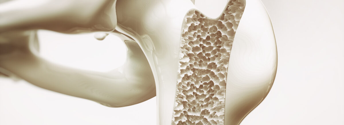 Osteoporosis: Understanding the Silent Bone Thief