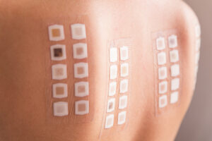 Understanding Patch Tests for Contact Dermatitis Diagnosis