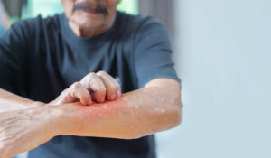 Drug Allergies: Allergic reactions to medications.