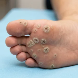 Plantar Warts