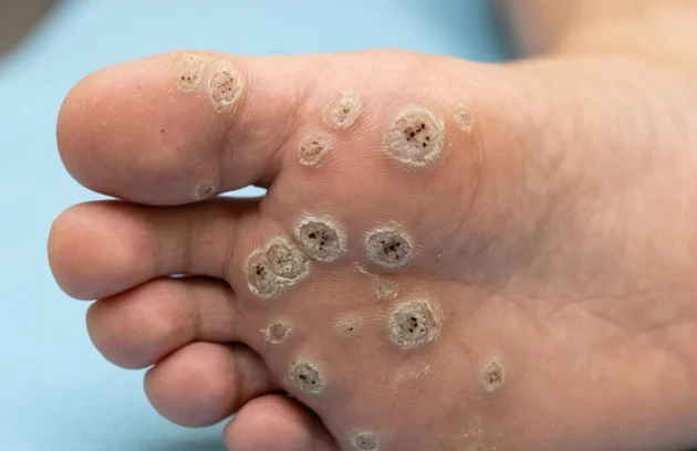 Plantar Warts