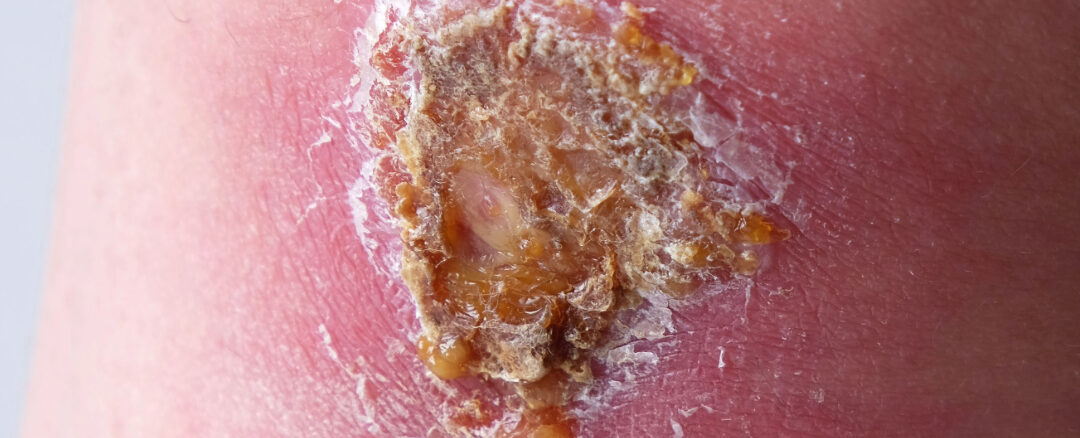 Signs of an Infected Wound