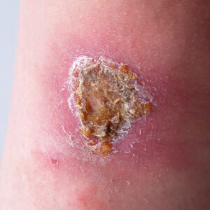 Signs of an Infected Wound