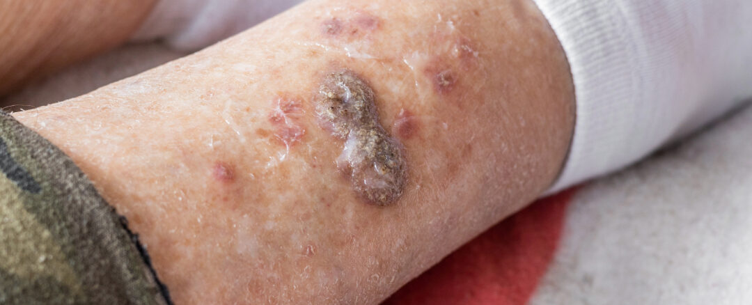 Acute vs. Chronic Wounds