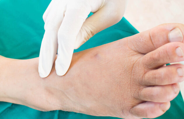 Charcot Foot
