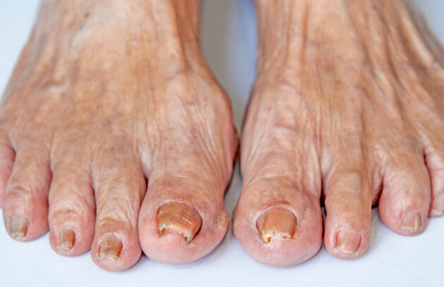 Toenail Abnormalities