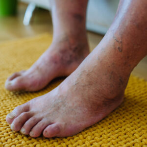 Managing Complex Peripheral Artery Disease in Diabetic Patients