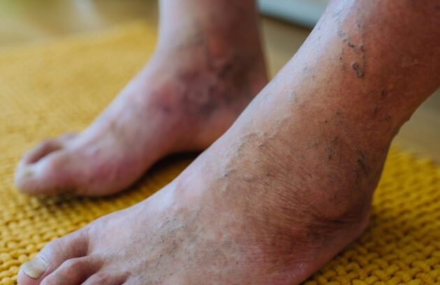 Managing Complex Peripheral Artery Disease in Diabetic Patients