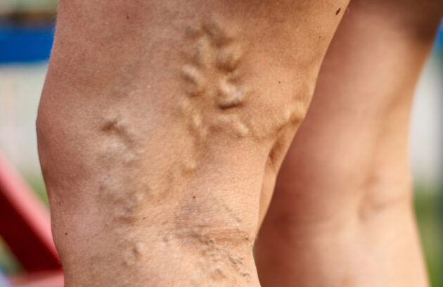 Personalized Anticoagulation Strategies in Patients with Venous Thromboembolism: Outline