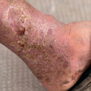 What Are Chronic Wounds and How Are They Treated?