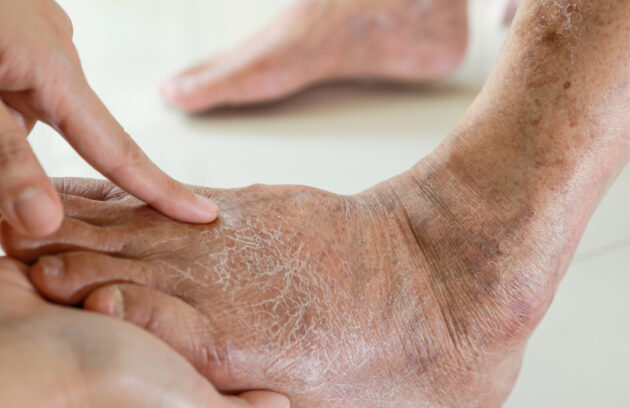 What Causes Numbness in the Feet and When to See a Doctor