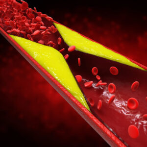 How to Prevent Blood Clots When Traveling Long Distances