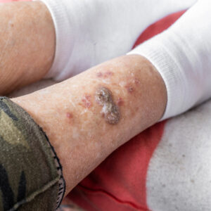 Understanding Pressure Ulcers: Prevention and Treatment