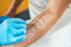 Diagnosing & Treating Allergy Symptoms